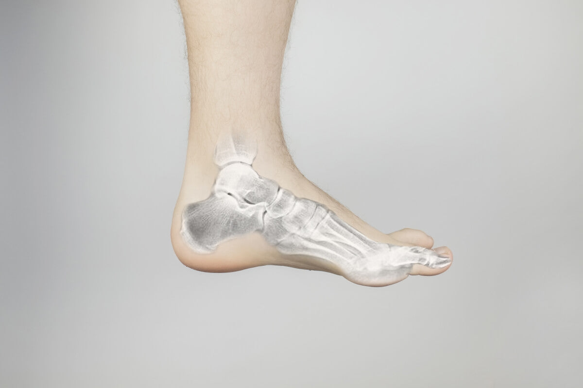 Stress Fractures in Runners: Warning Signs You Shouldn't Ignore
