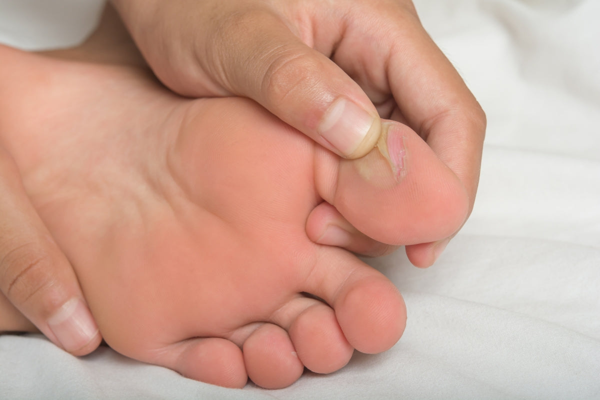 Foot blisters